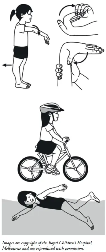 hypermobility-syndrome