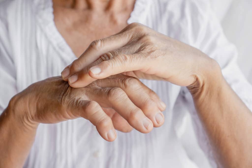 reactive-arthritis-hands